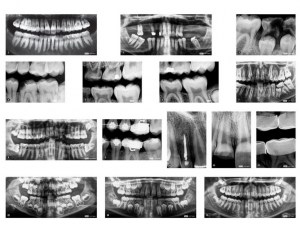 Radiografias dentales3